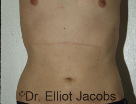 Male breast, after Torsoplasty treatment, front view, patient 2