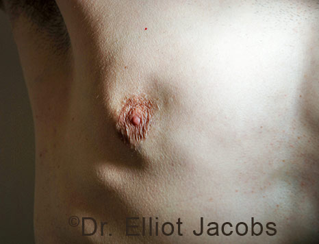 Men's breast, before Crater Deformity Repair treatment, front view, patient 7