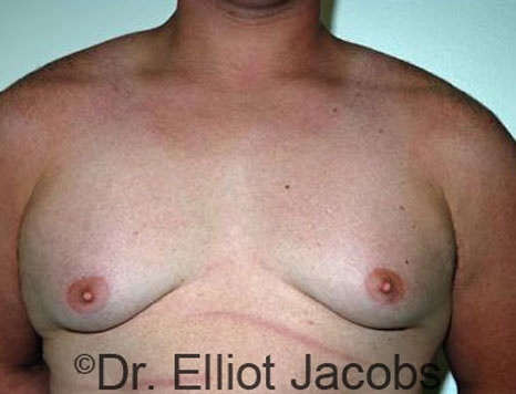 Obese Men, bfore Gynecomastia Surgery, front view, patient 1