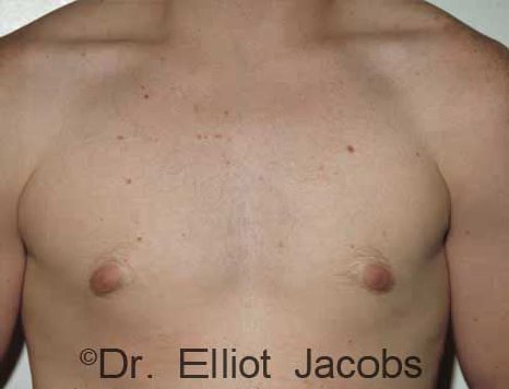 Male breast, before gynecomastia Adolescent treatment, front view, patient 1