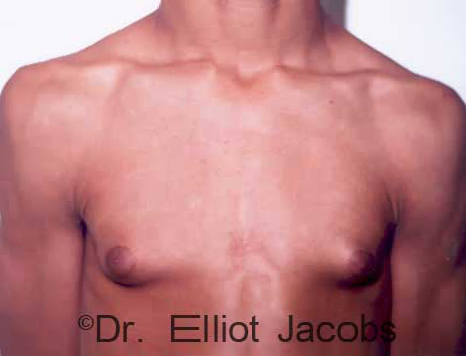 Male breast, before Adolescent Gynecomastia treatment, front view, patient 1